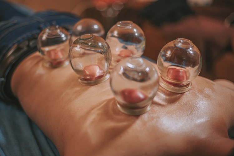 Bekam (Cupping)